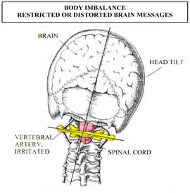 Misaligned Skull on Atlas and Neck